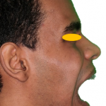 Abertura bucal após 23 dias. Imagens autorizadas pelo paciente.