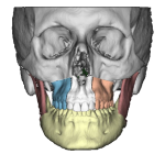 Planejamento-Cirurgico-Digital-para-Cirurgia-Ortognática