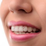 depositphotos_93189894-stock-photo-dental-medical-care-invisible-braces