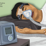 Depiction_of_a_Sleep_Apnea_patient_using_a_CPAP_machine – Copia