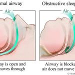HW-AirwayNormalObstructed_0 – Copia
